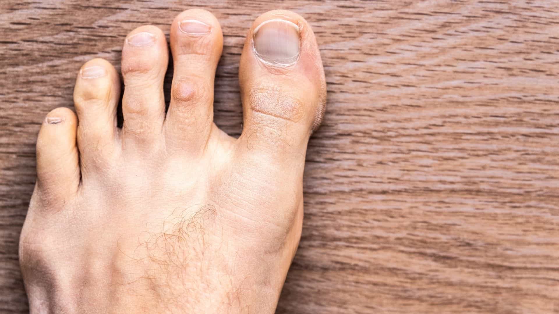 toe cramp